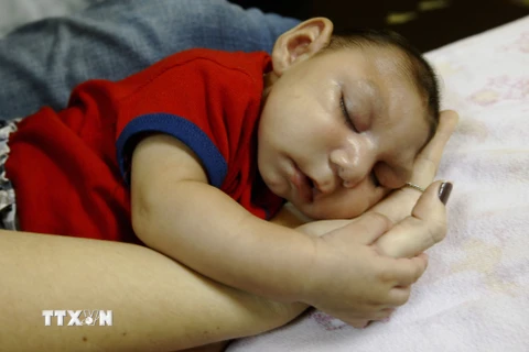 Một em bé bị chứng đầu nhỏ liên quan tới virus Zika. (Nguồn: THX/TTXVN)