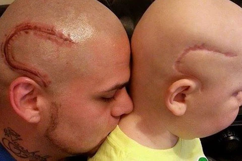 Ông bố xăm hình vết sẹo giống vết mổ phẫu thuật não của con trai. (Nguồn: BBC)