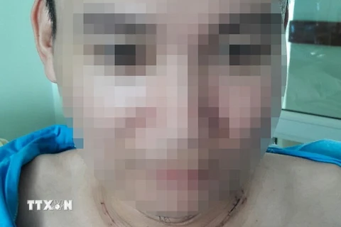 Bệnh nhân Huỳnh Thanh Hùng được phẫu thuật ung thư tuyến giáp. (Ảnh: Đinh Văn Nhiều/TTXVN)