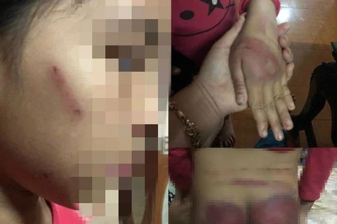 Làm rõ vụ một bé gái ở Thanh Hóa nghi bị bố đẻ bạo hành