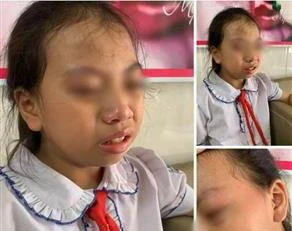 Hình ảnh nữ học sinh lớp 4 Trường Tiểu học Nguyễn Trãi, huyện Bắc Quang (Hà Giang) bị giáo viên tát vào má được người nhà học sinh đưa lên mạng xã hội. (Ảnh: TTXVN)