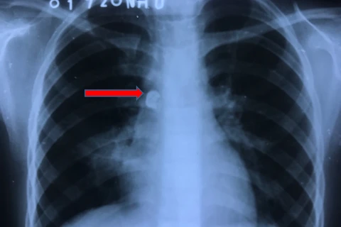Hình ảnh X-quang cho thấy dị vật nằm trong phổi. Ảnh minh họa. (Nguồn: bvndtp.org.vn)
