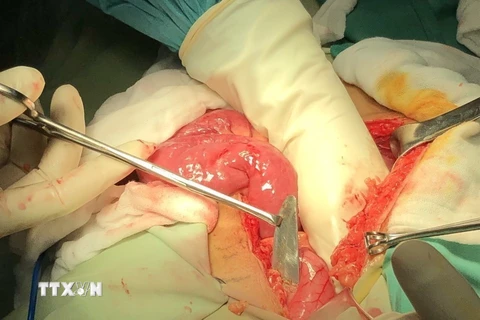 Bác sỹ Bệnh viện Đa khoa tỉnh Bạc Liêu phẫu thuật lấy lưỡi dao trong bụng bệnh nhân Lưu Kỳ Sang. (Ảnh: Tuấn Kiệt/TTXVN)