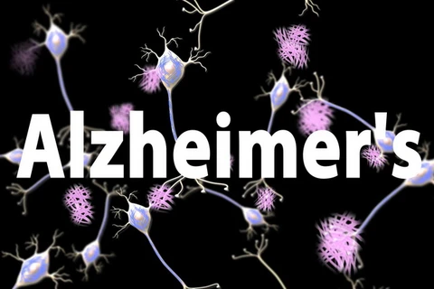 Trung Quốc: ​Phát hiện hai biến thể gene mới gây bệnh Alzheimer 