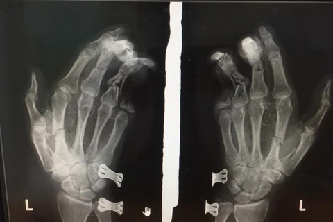 Phim chụp bàn tay của nam thanh niên bị tổn thương do điện thoại phát nổ.