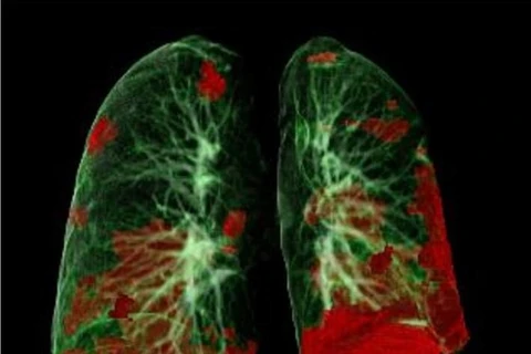 Chụp CT phổi của bệnh nhân cho thấy tổn thương COVID-19 màu đỏ. (Nguồn: healthcare-in-europe.com)