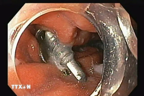 Hình ảnh chiếc đinh vít trong dạ dày bệnh nhân. (Ảnh: TTXVN phát)