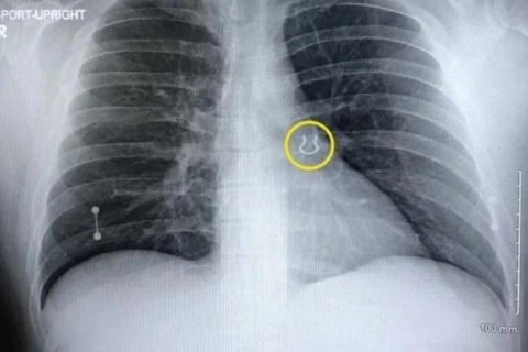 Người đàn ông tìm thấy khuyên mũi trong phổi sau 5 năm thất lạc