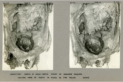 Hình ảnh chụp cắt lớp cho thấy bào thai thứ hai trong xác ướp ở Ai Cập. (Nguồn: Miami Herald)