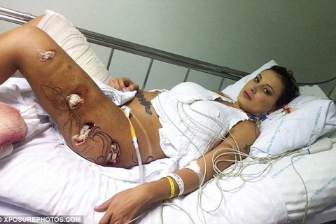 Hình ảnh đáng sợ của á hậu sắp mất chân vì phẫu thuật thẩm mỹ
