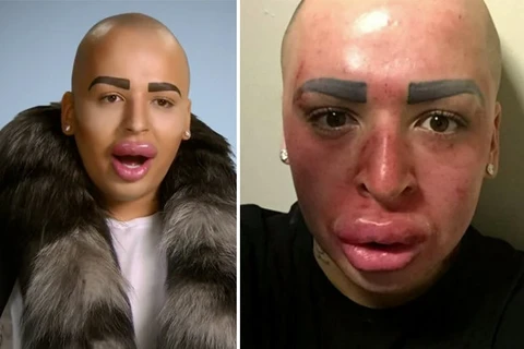 Mặt biến dạng khủng khiếp vì phẫu thuật cho giống Kim Kardashian