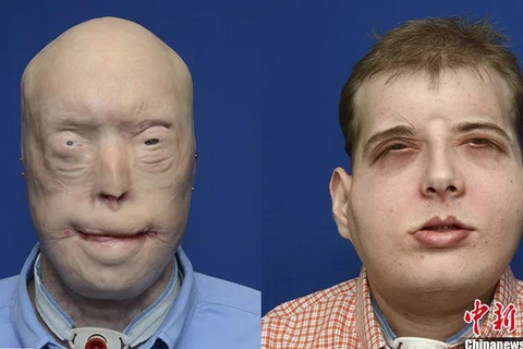 [Photo] Sửng sốt với ca phẫu thuật biến đổi mặt khó nhất thế giới