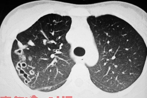 Nhìn thấy rõ những lỗ hổng trên lá phổi của Tiểu Hạ khi chụp CT. (Nguồn: xinhuanet.com)