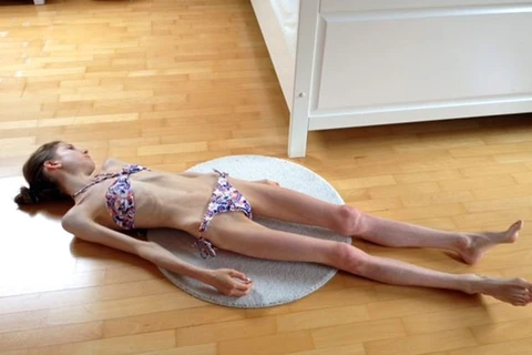 Chiara Schober khi còn da bọc xương. (Nguồn: mirror.co.uk)