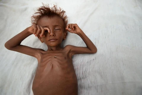 Một cậu bé bị suy dinh dưỡng nằm trên một chiếc giường bên ngoài túp lều của gia đình ở quận al-Tuhaita, Yemen. (Nguồn: Reuters)