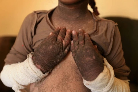 Làn da của cô bé sau khi chơi gần khu vực bị nã rocket.(Nguồn: Reuters)
