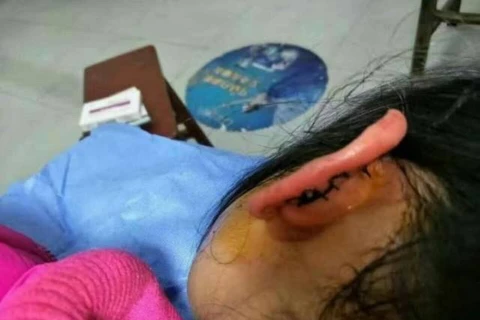 Vết thương ở tai của bé gái. (Nguồn: china.com)