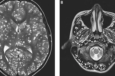 Kết quả chụp MRI cho thấy chàng trai có nhiều nang trong vỏ não (hình bên trái là các chấm trắng). Các tổn thương cũng được tìm thấy trong thân não và tiểu não của anh ta (nhìn bên phải). (Nguồn: dailymail.co.uk) 