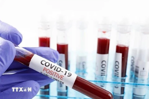 Các nhà khoa học thuộc trường Y khoa Stanford của Mỹ thành công trong thử nghiệm phát hiện các kháng thể chống lại virus SARS-CoV-2 gây dịch COVID-19. (Nguồn: Getty Images/TTXVN) 