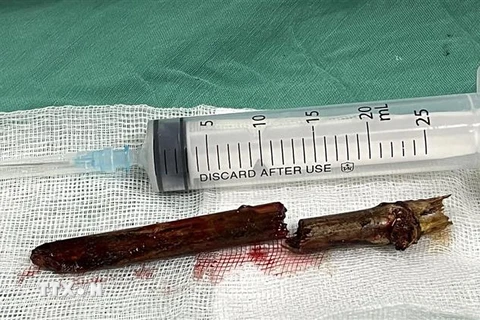 Thanh tre đâm vào cổ nam bệnh nhân được các bác sỹ Bệnh viện đa khoa Hùng Vương phẫu thuật lấy ra. (Ảnh: Trung Kiên/TTXVN) 