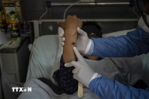 Nốt đậu mùa khỉ trên tay một bệnh nhân. (Ảnh: AFP/TTXVN) 