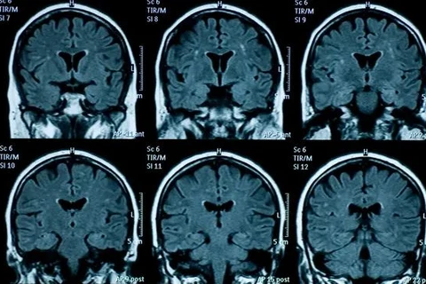 ​Sức khỏe tâm thần giảm sút đi đôi với những thay đổi về cấu tạo vật lý của não bộ ở thiếu niên. (Nguồn: Getty Images)
