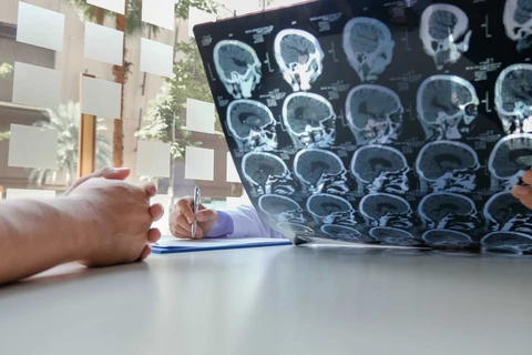 Công nghệ dựa trên trí tuệ nhân tạo (AI) đã giúp tăng đáng kể hiệu quả chữa trị bệnh nhân đột quỵ tại Anh. (Nguồn: Open Access News)