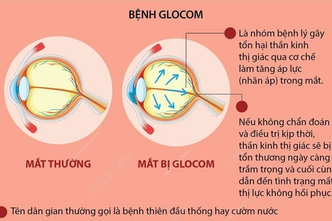 [Infographics] Tuần lễ Glocom Thế giới: Tầm soát và phát hiện bệnh sớm