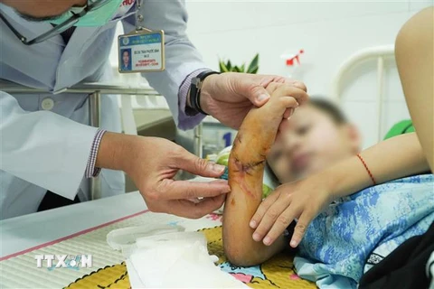 Bác sỹ kiểm tra bàn tay bị đứt lìa sau khi nối thành công cho bé trai. (Ảnh: TTXVN phát)