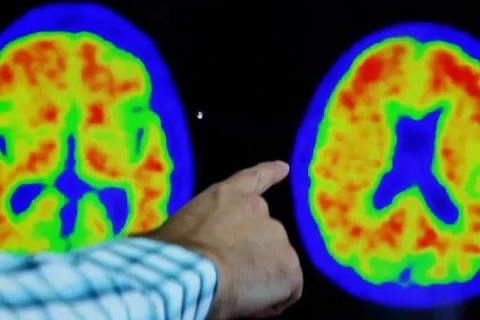 Hình ảnh não của bệnh nhân Alzheimer khi chụp PET. (Nguồn: Reuters)