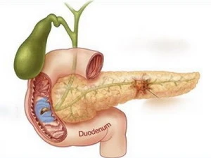 Triệu chứng của bệnh ung thư tụy. Ảnh minh họa. (Nguồn: ungthuvn.com)