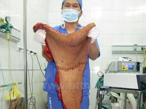 Khối u của bệnh nhân được các bác sỹ tách ra sau khi phẫu thuật. (Ảnh: PV/Vietnam+)