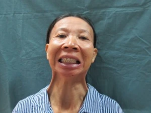 Bệnh nhân Nguyễn Thị D trước khi phẫu thuật không thể há được miệng. (Ảnh: PV/Vietnam+)