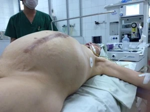 Phẫu thuật cắt bỏ khối u nặng 14kg cho một phụ nữ