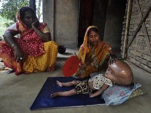 Bé gái Roona Begum tại nhà ở làng Jirania thuộc bang Tripura, đông bắc Ấn Độ ngày 13/4, trước khi phẫu thuật. (Nguồn: AFP/TTXVN)