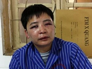 Phóng viên Thế Dũng (Báo Người lao động) tại Bệnh viện đa khoa Lạng Sơn khi bị đánh ngày 6/1/2010. (Ảnh: NLĐ)
