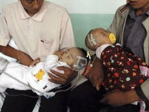 Trẻ em Trung Quốc bị ngộ độc do dùng sữa nhiễm melamin. (Ảnh: Internet)