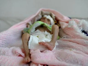 Một em bé bị suy dinh dưỡng tại thủ đô Sanaa của Yemen. (Nguồn: THX/TTXVN)