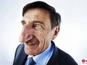 Người đàn ông có chiếc mũi dài nhất thế giới. (Nguồn: Internet)