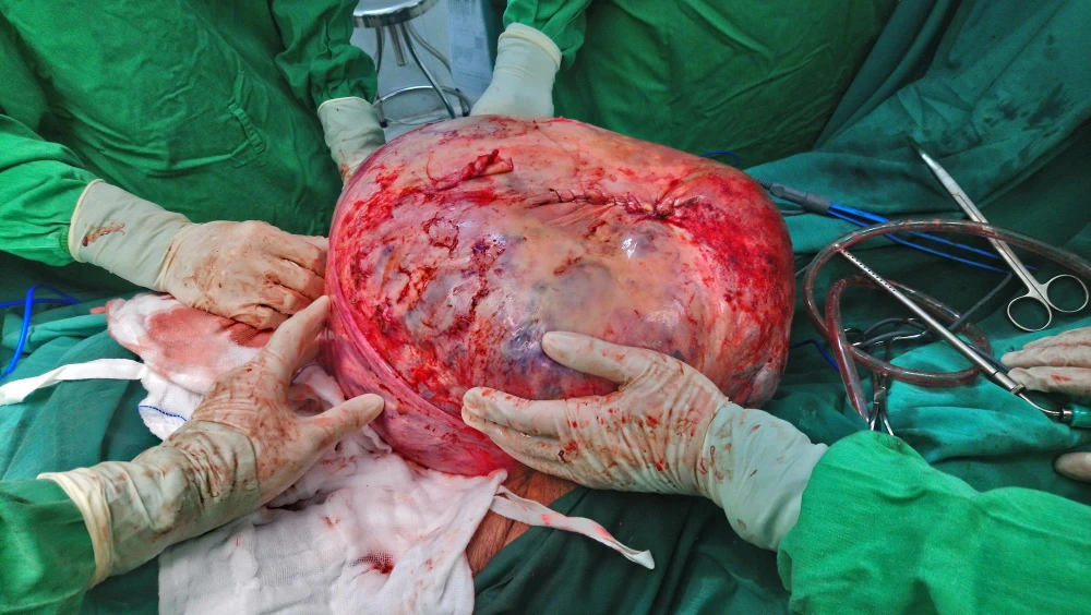 Khối u bồng trứng khổng lồ nặng 30kg sau khi đưa ra khỏi ổ bụng bệnh nhân 78 tuổi. (Ảnh: TTXVN)
