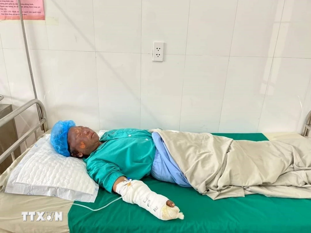 Bệnh nhân Lù A Chơ (sinh năm 1972) bị bỏng độ 1, đang điều trị tại Bệnh viện Đa khoa khu vực Nghĩa Lộ. (Ảnh: TTXVN phát)