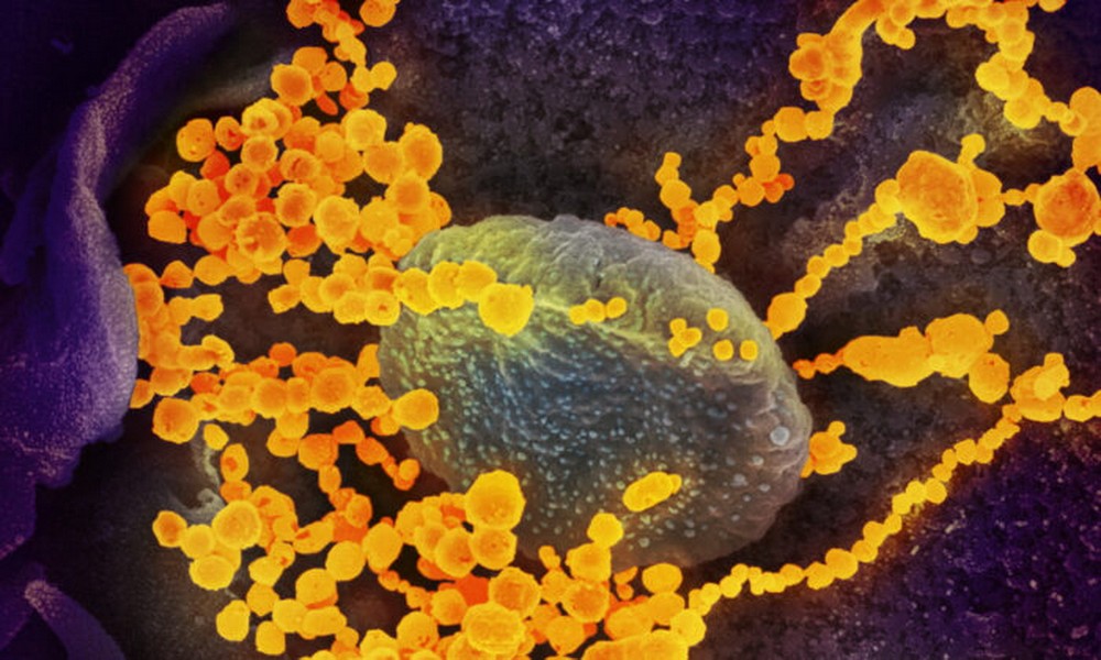 Kính hiển vi điện tử cho thấy hình ảnh của SARS-CoV-2 (vật thể tròn màu vàng), gây bệnh COVID-19, đang xuất hiện từ các tế bào nuôi cấy. (Ảnh: The Epoch Times)