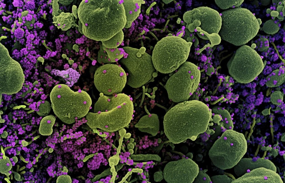 Hình ảnh quét qua kính hiển vi điện tử cho thấy tế bào (màu xanh) bị virus SARS-COV-2 (màu tím) xâm nhập. (Ảnh: AFP/TTXVN)