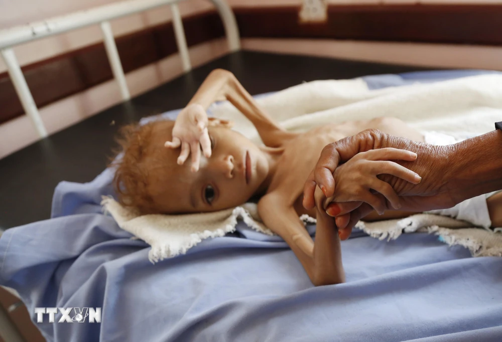 Trẻ em bị suy dinh dưỡng điều trị tại bệnh viện ở tỉnh Hajjah, Yemen. (Ảnh: THX/TTXVN)