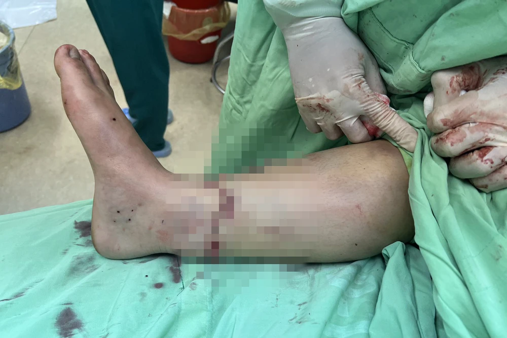 Sau 5 tiếng phẫu thuật, các bác sỹ Bệnh viện Đa khoa vùng Tây Nguyên đã nối liền thành công bàn chân bị đứt rời của bệnh nhân. (Ảnh: Bệnh viện Cung cấp)