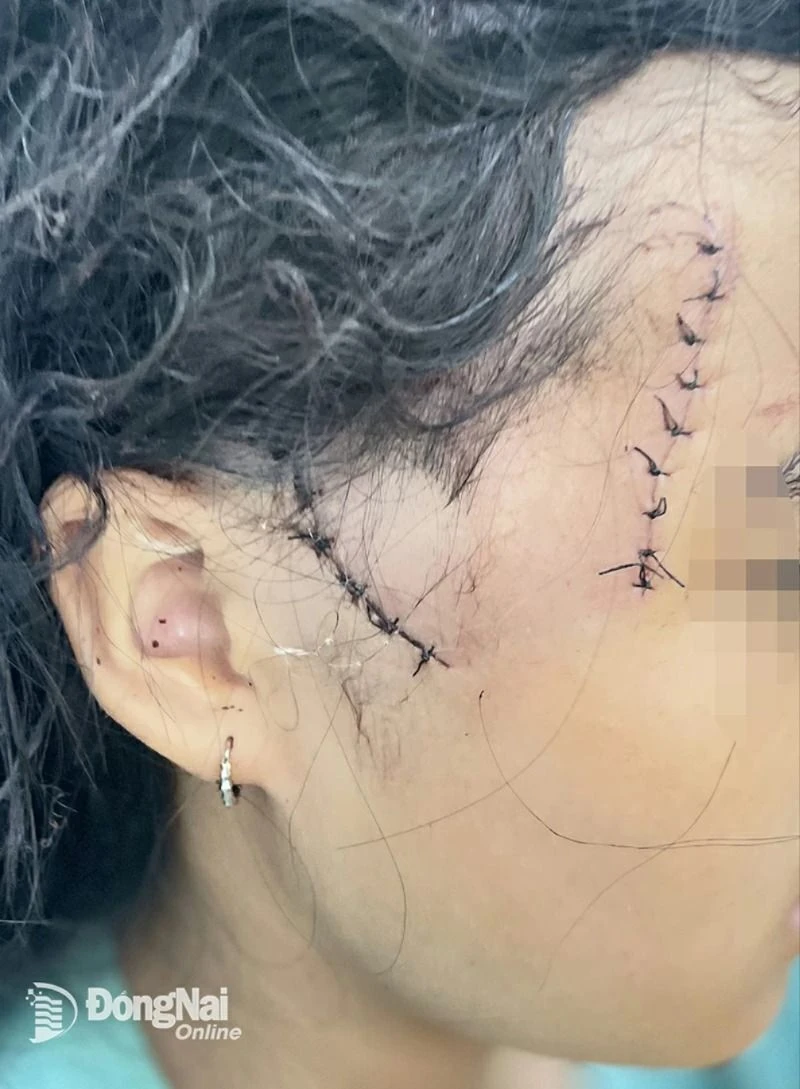 Bé gái 13 tuổi bị nhiều vết dao chém vào vùng mặt, đầu. (Nguồn: Báo Đồng Nai)