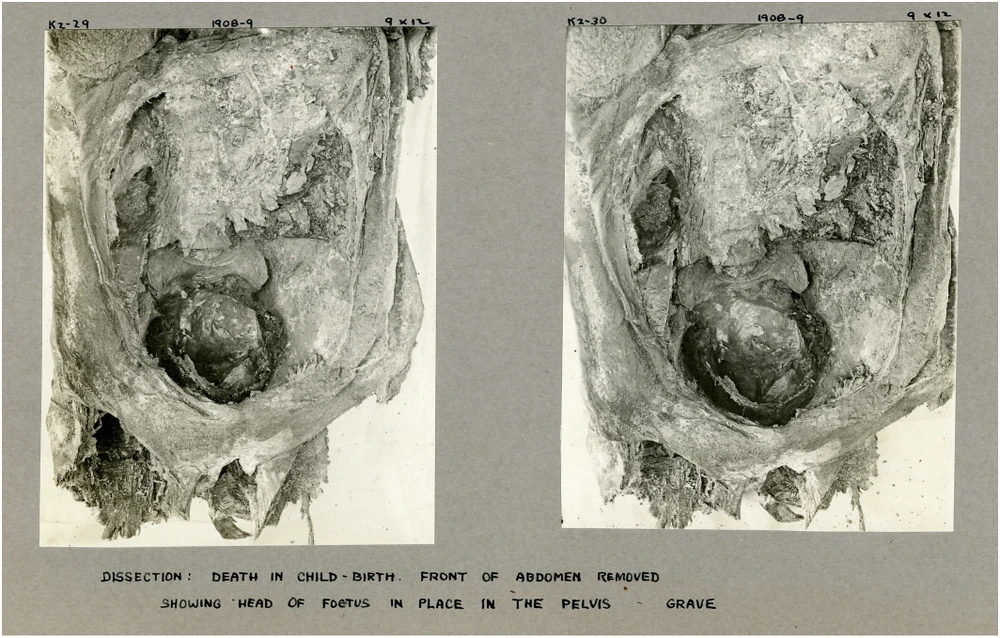 Hình ảnh chụp cắt lớp cho thấy bào thai thứ hai trong xác ướp ở Ai Cập. (Nguồn: Miami Herald)