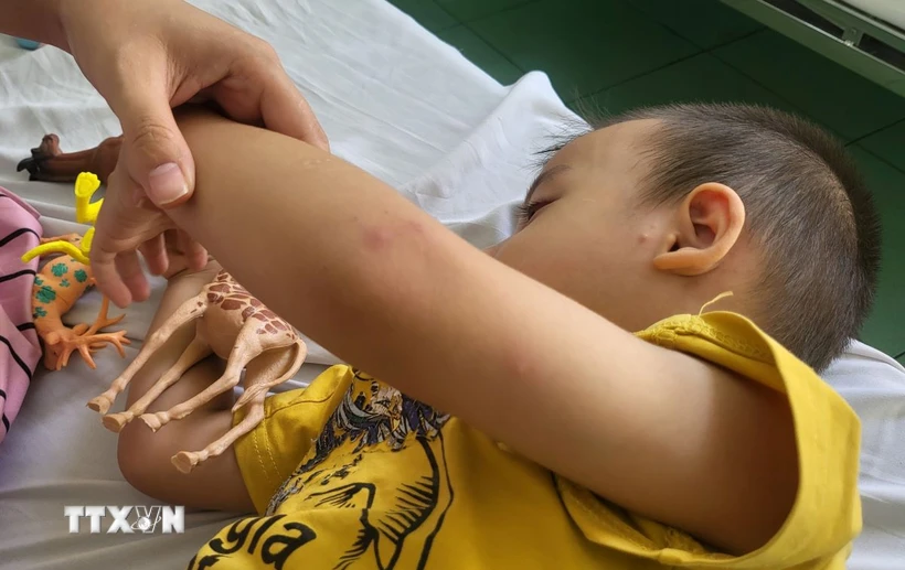 Một bệnh nhi mắc bệnh tay chân miệng đang điều trị nội trú tại Bệnh viện Nhi đồng 2 Thành phố Hồ Chí Minh. (Ảnh: Đinh Hằng/TTXVN)